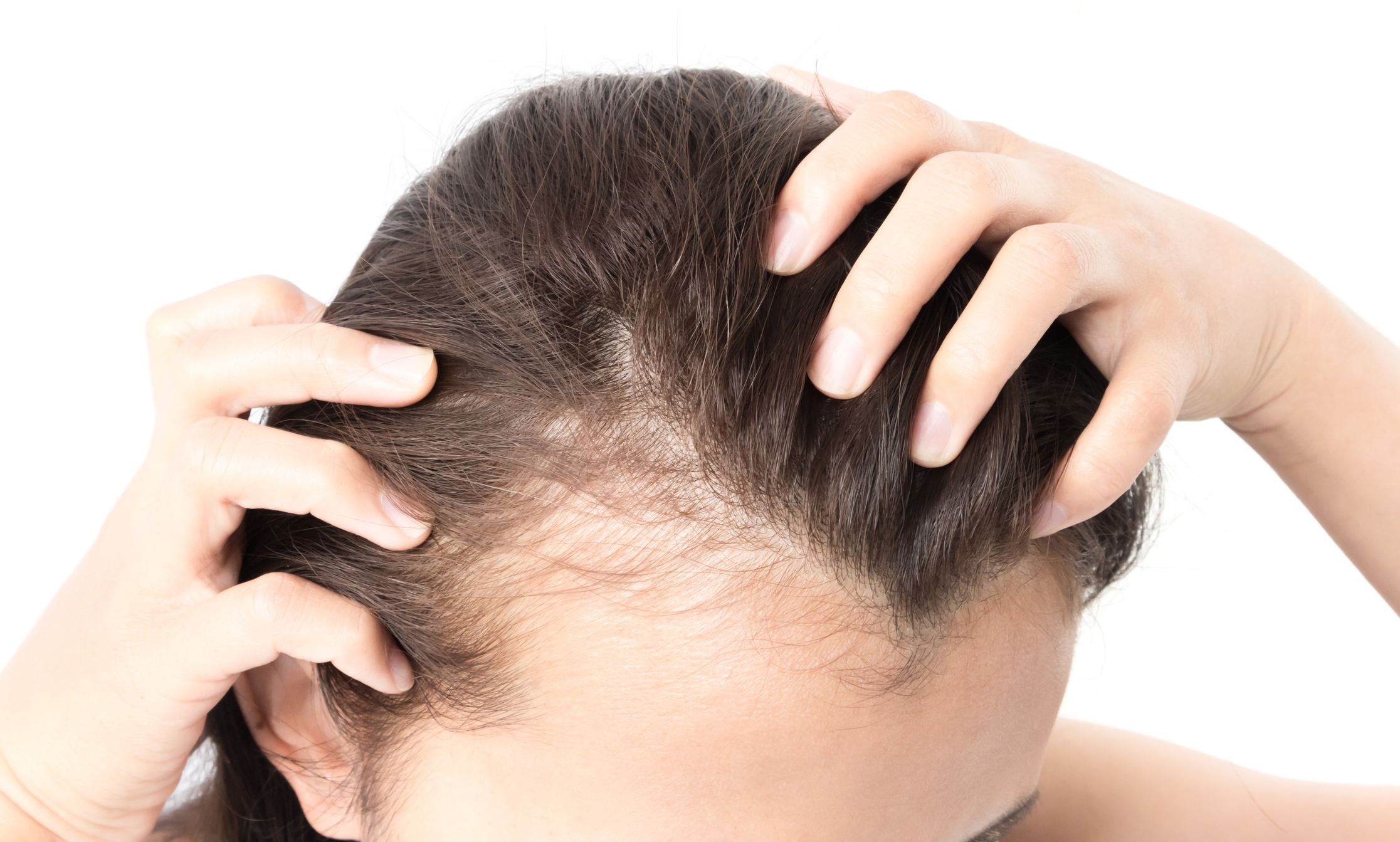 Woman serious hair loss problem for health care shampoo